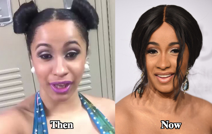 Cardi B Before And After Plastic Surgery Boobs Teeth Vrogue Co